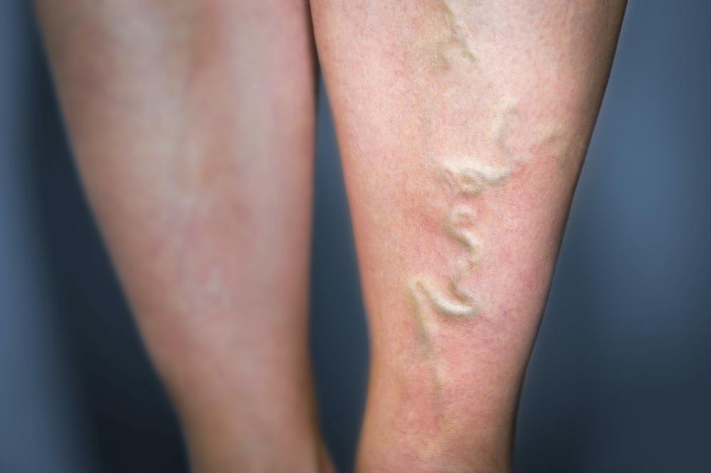 Why Are Women More Susceptible To Varicose Veins Central Coast Vein And Vascular